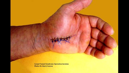 Carpal Tunnel Syndrome - Do You Need Surgery?