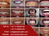 Best dental implants treatment in South Delhi, best dentist in new delhi, dental implant centre in Safdarjung Enclave delhi