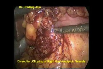 Dr Pradeep Jain- STOMACH- Laparoscopic D2 Radical Gastrectomy