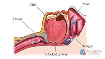 Different Types of Sleep Apnea, Dentist Dr. Larry Pribyl, Independence, Missouri