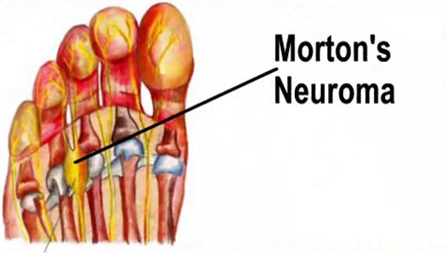 Morton’s Neuroma - Podiatrist in North Ridgeville, Elyria OH - George Costaras