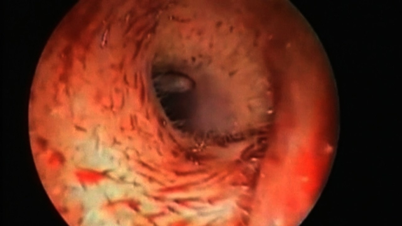 Fruit fly larvae infest woman's ear