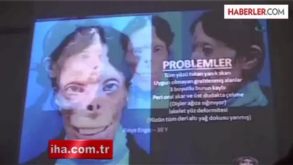 Gaziantepli Doktordan Çığır Açacak Nakilsiz Yüz