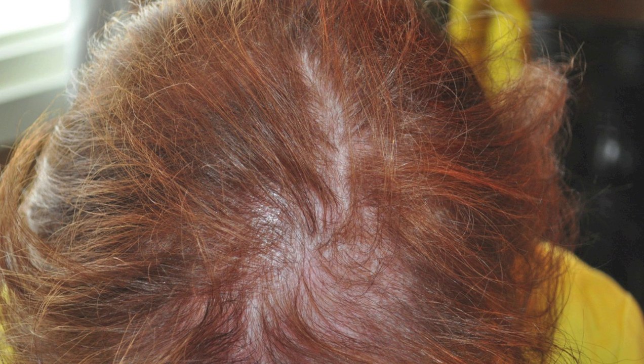 Getting started helping clients with hair loss