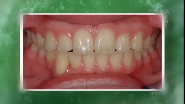 Littleton Braces Dec2013