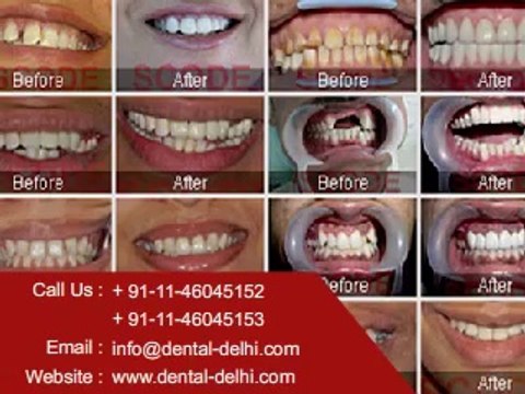 Dental Clinic in New Delhi, Dentist in South Delhi, Dental Implants Clinic in Delhi