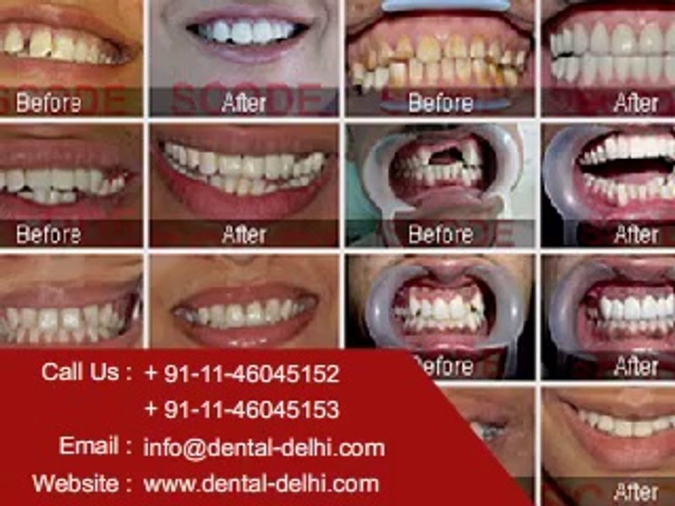 Cosmetic Dentistry In Delhi, Dental Delhi, Dentist in Delhi, Dental Clinic in Safdarjung Enclave