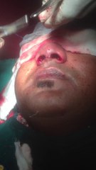 rhinoplasty surgery in bangalore