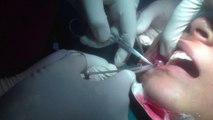 cheek fat removal surgery in india