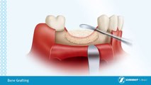 bone grafting orlando kissimmee ocala sinus lift ridge preservation tampa, tooth replacement deland