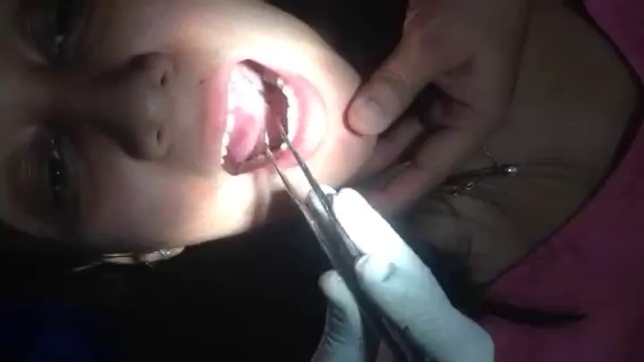 Laser Frenectomy in Delhi India, Frenectomy Surgery India, Laser Frenectomy Surgery Delhi