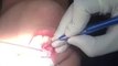 Laser Frenectomy Treatment in Safdarjung Enclave, Tongue Tie Release using Laser, Frenectomy surgery dental clinics South Delhi