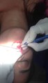 Laser Frenectomy Treatment in Safdarjung Enclave, Tongue Tie Release using Laser, Frenectomy surgery dental clinics South Delhi