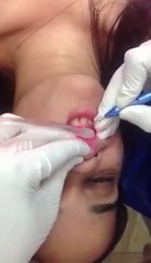 Frenectomy by Laser in south delhi, Ankyloglossia Treatment in Africa Ave, Periodontal Frenectomy Care in Safdarjung Enclave