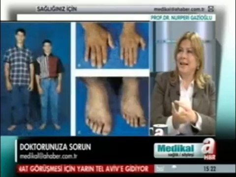 Prof. Dr. Nurperi Gazioğlu, akromegali hastalığı hakkında bilgiler veriyor part 1