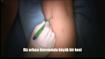 Çarpık Parantez  Bacak Estetiği : Ahmet Karacalar, Prof. Dr.
