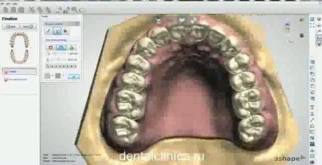 Hi-Tech моделирование протезов нужней и верхней челюсти European Clinic of Aesthetic Dentistry