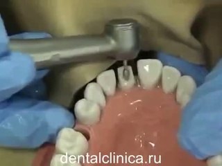 Клиника эстетической стоматологии, металлокерамика, циркониевая коронка центральный резец, профессиональная стоматология