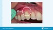 Soft tissue grafting the villages, orlando, oral surgeon the villages, leesburg, implant dentists