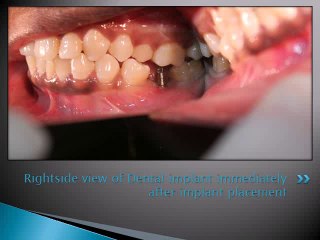 BASAL IMPLANT IN CHENNAI