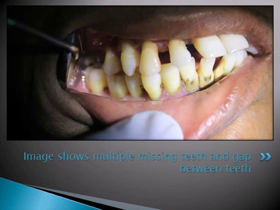 DENTAL IMPLANT FOR DIABETIC PATIENT WITH SEVERE PERIODONTITIS