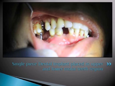 DENTAL IMPLANT FOR LONG TERM MISSING MOLAR TEETH