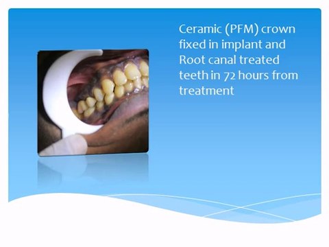 DENTAL IMPLANT FOR REPLACEMENT OF DECAYED MOLAR TEETH