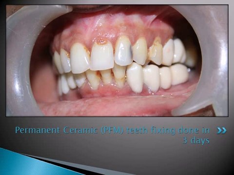 DENTAL IMPLANT FOR RIGHT MOLAR TEETH REPLACEMENT