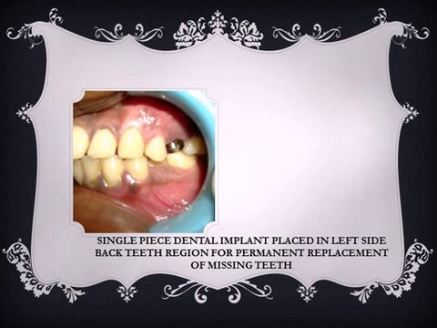 FLAPLESS DENTAL IMPLANTS IN INDIA