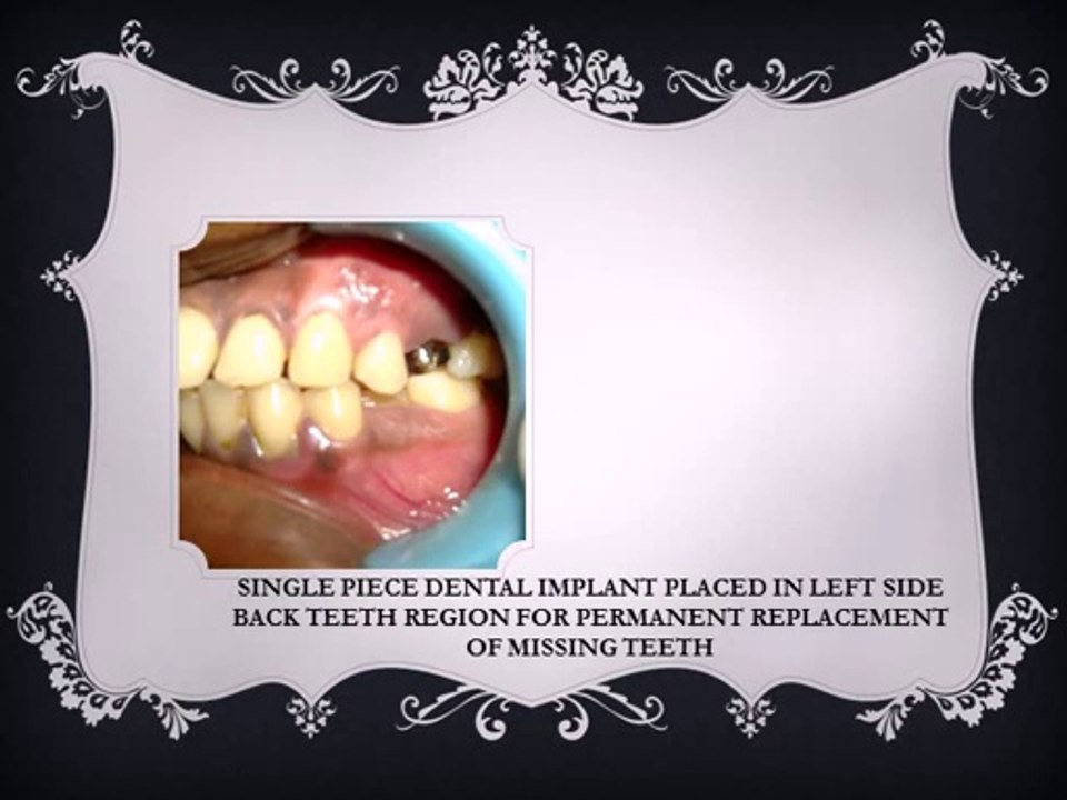 FLAPLESS DENTAL IMPLANTS IN INDIA