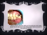 FLAPLESS DENTAL IMPLANTS IN INDIA_0