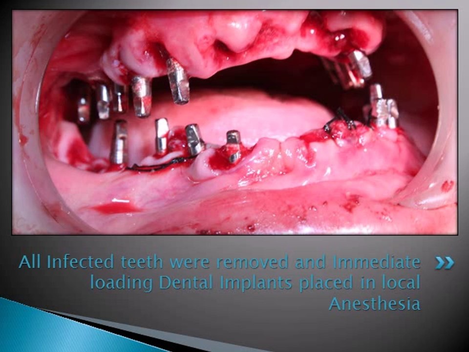 FULL MOUTH REHABILITATION WITH DENTAL IMPLANT FOR PERIODONTITIS CONDITION