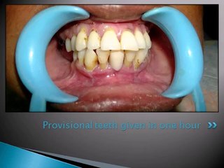 IMMEDIATE DENTAL IMPLANT FOR LOWER FRONT TEETH