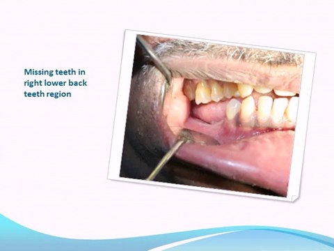 IMMEDIATE DENTAL IMPLANTS FOR MOLAR TEETH