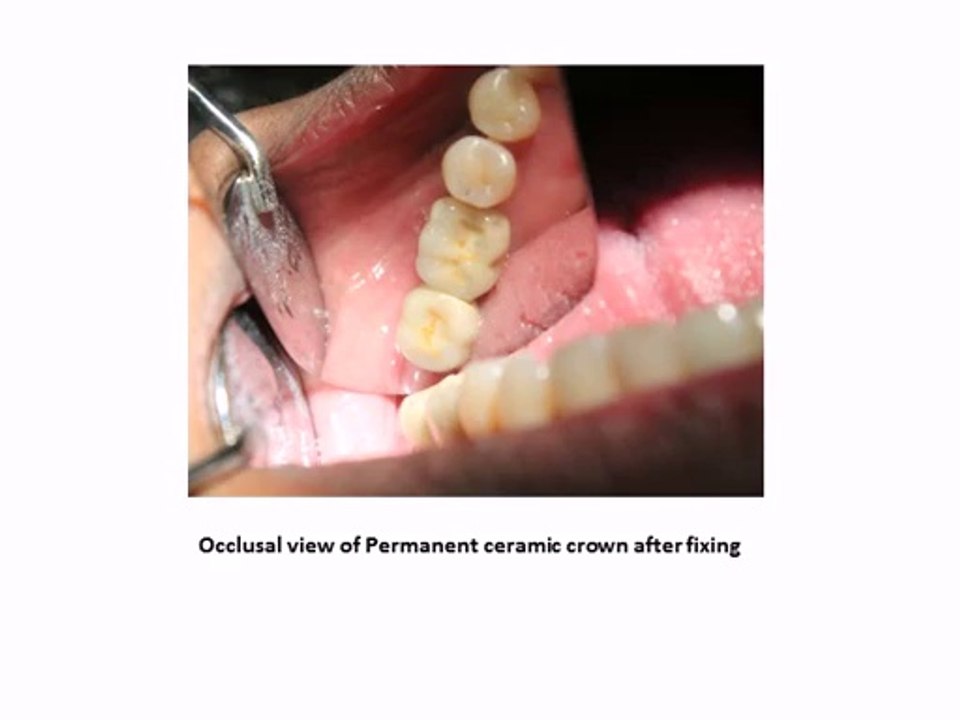 KOS BCS DENTAL IMPLANTS IN INDIA