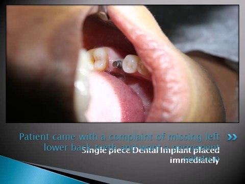 LOWER LEFT MOLAR REPLACEMENT WITH DENTAL IMPLANTS
