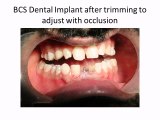 PAINLESS DENTAL IMPLANTS IN INDIA_0