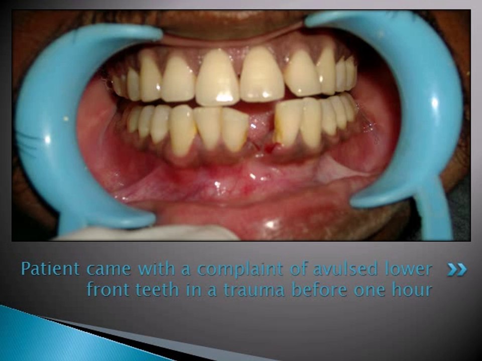 REPLACEMENT OF MISSING LOWER FRONT TEETH WITH IMPLANT