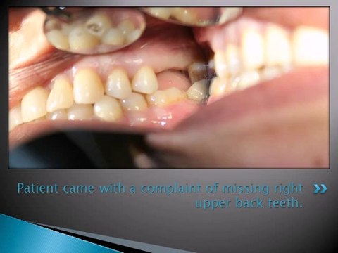 REPLACEMENT OF MISSING MOLAR TEETH WITH DENTAL IMPLANT