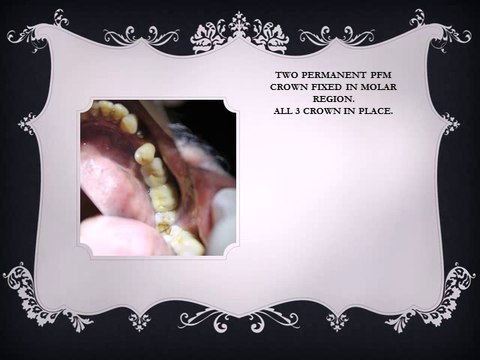 REPLACEMENT OF MISSING MOLAR TEETH WITH DENTAL IMPLANT_0