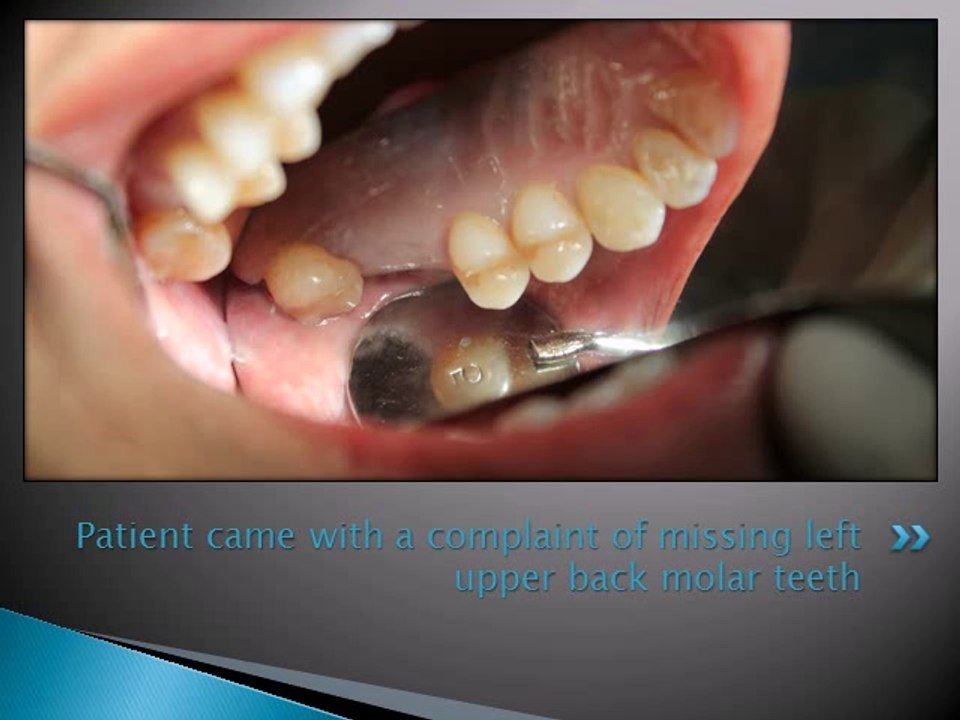 REPLACEMENT OF MISSING UPPER LEFT MOLAR TEETH WITH