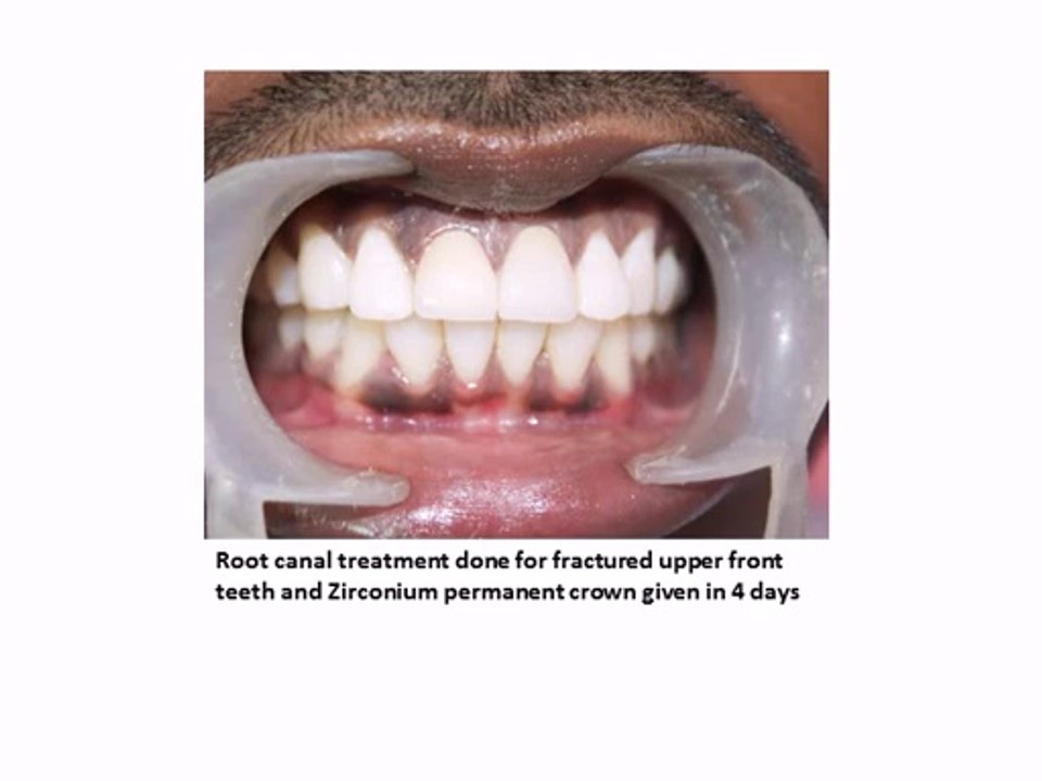 SMILE MAKEOVER FOR FRACTURED FRONT TEETH