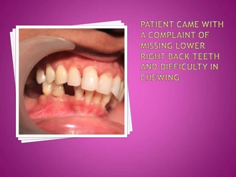 UPPER AND LOWER MOLAR REPLACEMENT WITH DENTAL IMPLANT