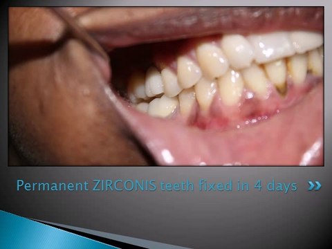 UPPER MOLAR REPLACEMENT WITH SINGLE PIECE DENTAL IMPLANT