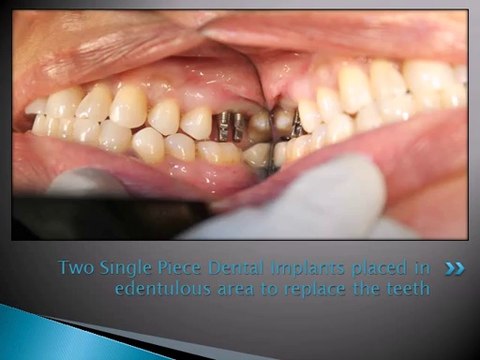UPPER RIGHT MOLAR TEETH REPLACEMENT WITH DENTAL IMPLANT