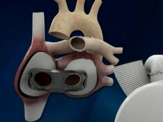 Décès du premier patient ayant bénéficié d'un coeur artificiel - 03/03