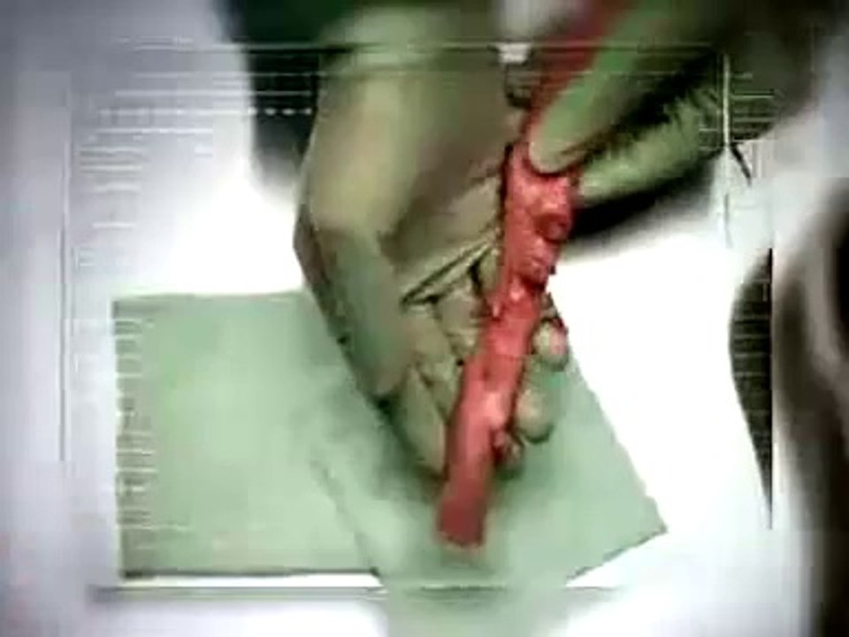 #4 Anti Cigarette Smoking Commercial Ad Artery, Stop it, it will kill you and others