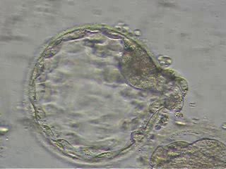 Embryo transfer with Spontaneously hatched Blastocyst at IdealFertilityClinic