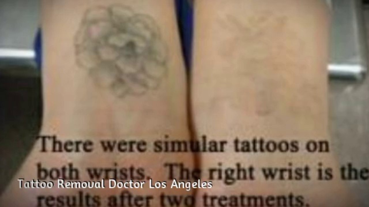 Laser Tattoo Removal Los Angeles | Tattoo Removal Los Angeles