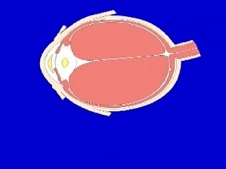 Retrobulbar Block Complication
